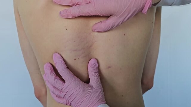 A teenager back shows horizontal blue-violet streaks along the spine