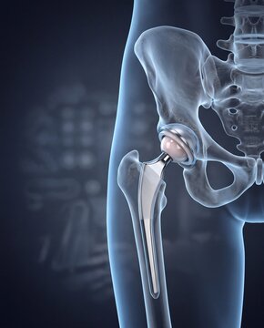 Translucent Pelvis with Total Hip Replacement Implant