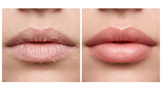 dry chapped lips treatment before and after | lip hydration skincare results comparison | healing peeling skin on lips macro photography | cosmetic lip filler effect and moisturizing balm
