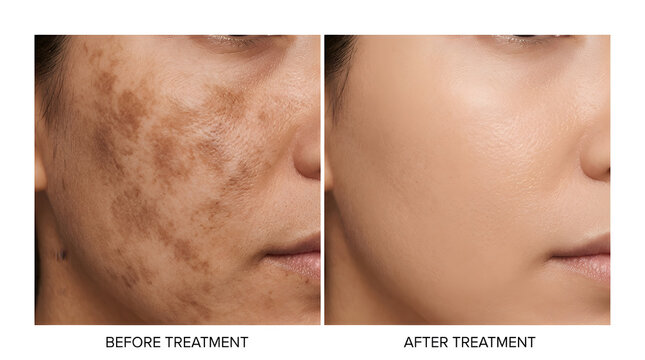melasma treatment before and after results | hyperpigmentation skin care success story | facial skin rejuvenation procedure comparison | clearing dark spots and sun damage on face