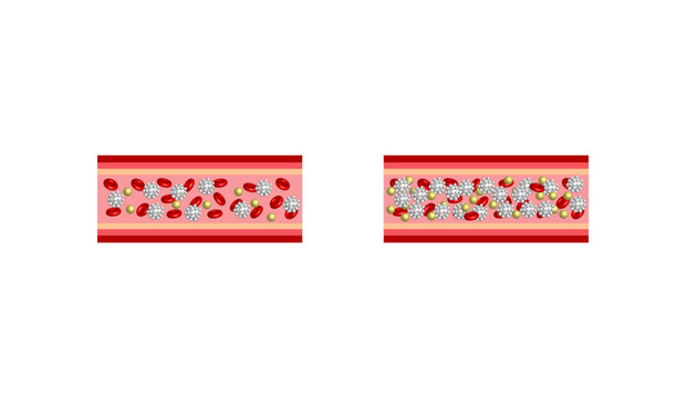Leukemia, blood cancer. Red blood cells, platelets and lymphocytes. Vector illustration.