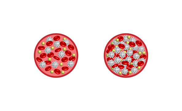 Leukemia, blood cancer. Red blood cells, platelets and lymphocytes. Vector illustration.
