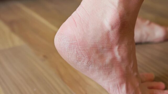 Close up of a dry cracked human heel highlighting the need for moisturizing foot care.