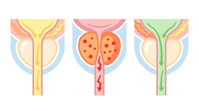 Medical diagram of prostate stages showing healthy gland, inflammation and enlarged condition for urology health education, clinical diagnostic aid