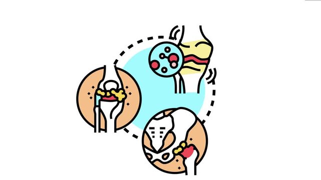 Human joints experiencing inflammation and degradation, symptoms of arthritis and associated pain in knees, elbows, and hips, a common rheumatic disease