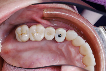Intraoral close-up view of screw-retained dental implant crown with access hole on patient upper jaw teeth. Concept of prosthodontics, tooth restoration, and dentistry treatment. © WIROT