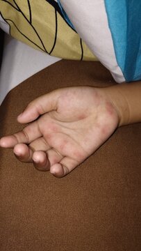 Hand Foot and Mouth Disease Rash on Child Palm Close Up Medical Condition