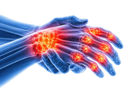  Closeup 3D illustration of hand finger joints arthritis with inflamed knuckles and pain
