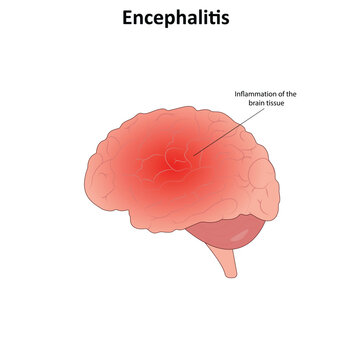 Encephalitis vector illustration