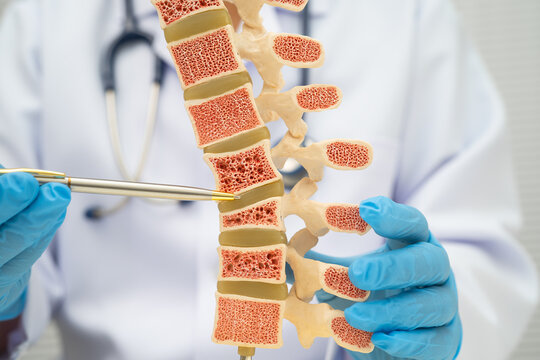 Doctor holding osteoporosis in back bone model for treatment medical in orthopedic department.