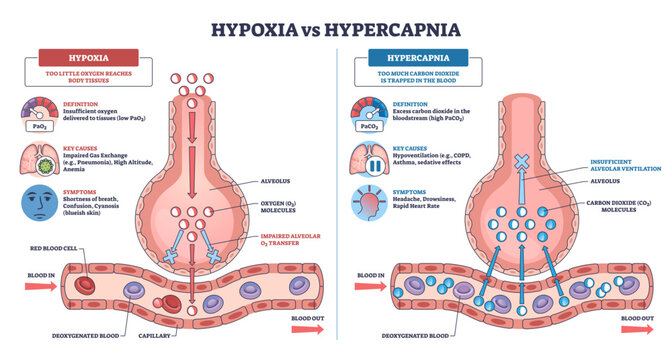 Hypoxia vs Hypercapnia comparison explains disrupted gas exchange using alveolus, capillary, and O2-CO2 molecules to contrast low oxygen and CO2 retention, transparent background