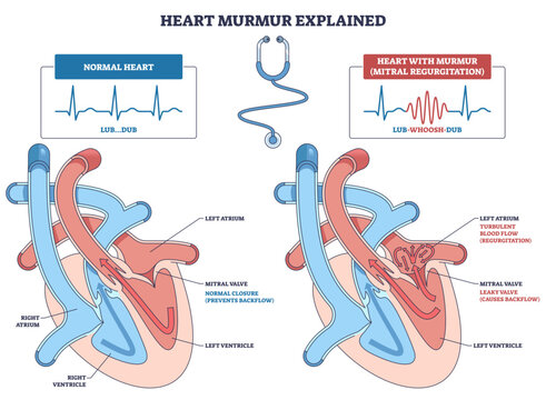 Heart murmur explained, brief comparison of normal heart and mitral regurgitation, illustrating turbulent backflow, transparent background. Key objects, mitral valve, chambers, ECG trace.