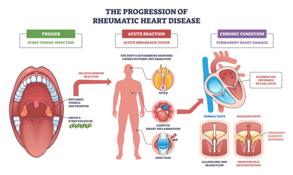 Rheumatic heart disease progression shown from strep throat to fever, carditis, and scarred mitral valve, key objects, throat, human figure, heart valve, transparent background