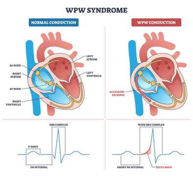 WPW syndrome diagram explains abnormal heart conduction via accessory pathway, contrasting normal flow and delta wave ECG, key objects, heart, accessory pathway, ECG, transparent background.