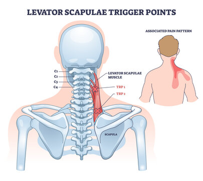 Levator scapulae trigger points illustrated with muscle highlights and referral pain path on neck and shoulder, key elements, levator scapulae muscle, cervical spine, scapula, transparent background.