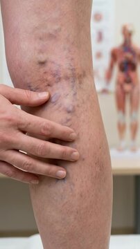 Venous system ailment: varicose vein, vascular problem, patient examination, leg condition, hand touch, health concern, doctor check, circulation issue.