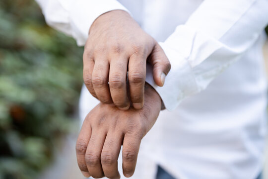 Hand closeup of South asian 20s young adult man scratching his itchy back of the hand from a mosquito bite or skin rash in outdoor green park scene, allergic reaction concept