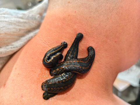 Medicinal leeches performing hirudotherapy treatment on a person's neck, a traditional alternative medicine involving bloodsucking worms for therapeutic purposes.