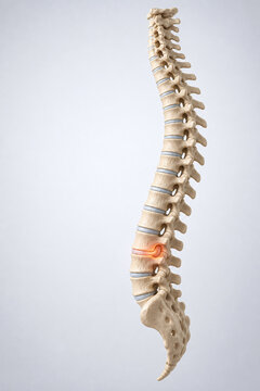 Glowing Herniated Disc in Detailed Human Spine Model