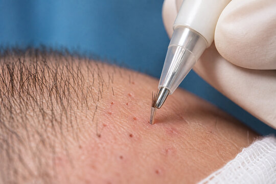 Macro hair transplant graft placement medical illustration