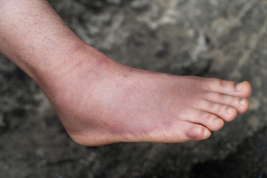 Swollen Foot After Cast Removal of Metatarsal Fracture