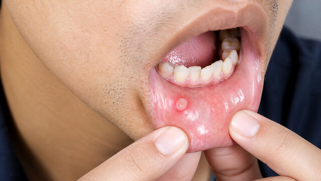 Extreme Close Up of a Minor Aphthous Ulcer on the Inner Lower Lip