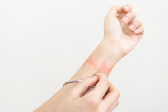 Dermatology asian young woman, girl allergy, allergic reaction dermatitis from wrist bracelet, jewelry on arm, hand in scratching itchy, itch red spot or rash of skin. Healthcare treatment beauty