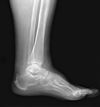 Developing exostoses on the calcaneus, Haglund's syndrome