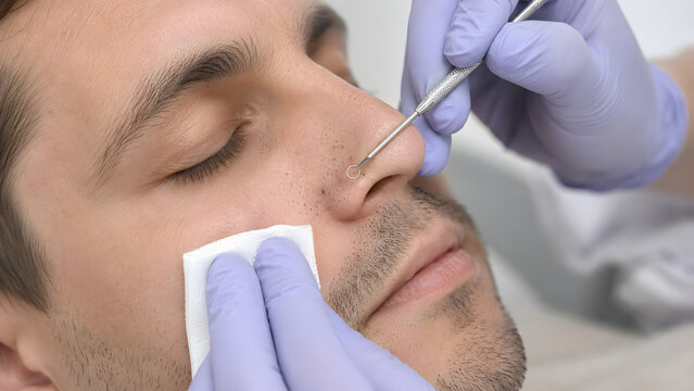 Dermatology professional extracts a comedone from a man's acne-prone nose using a metal instrument.