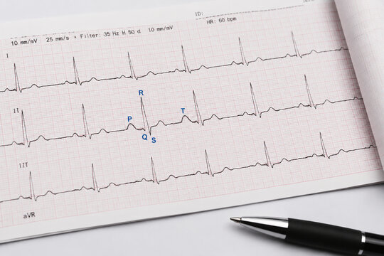 ECG printout with PQRST wave pattern on white table, medical heart health