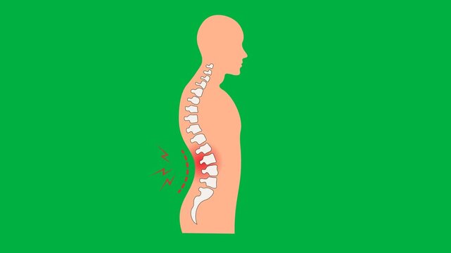 Medical vector animation displaying human torso profile with a vertebral column highlighting lumbar strain, herniated disc, sciatica, scoliosis, lordosis, ankylosing spondylitis chronic lower back