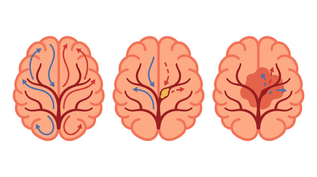 Top view of human brain anatomy showing stroke progression, blood clot blockage, medical illustration for neurology research, cardiovascular health