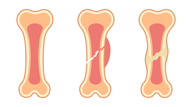 Three medical bone fracture stages showing healthy structure, partial break with hematoma, and complete bone fracture healing process
