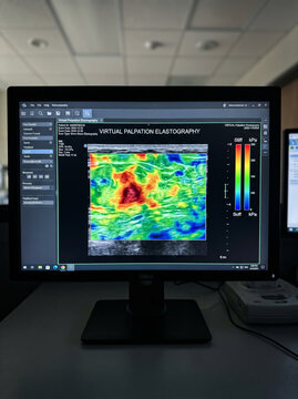 Computer Displaying Virtual Palpation Elastography Tissue Scan Map