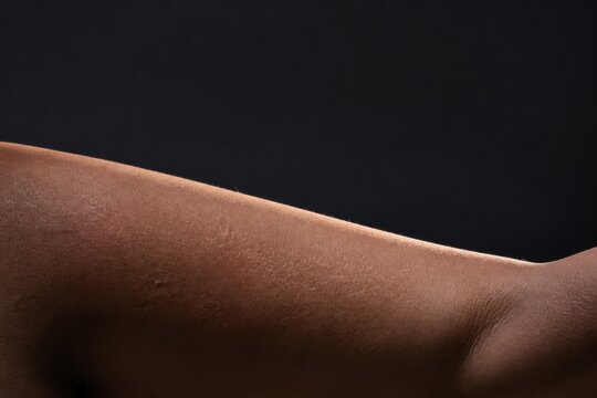 Close-up of Keratosis Pilaris Bumps on Human Arm Skin