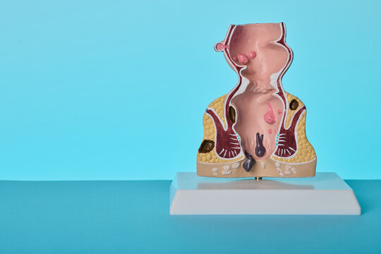 Rectum anatomical model on doctor desk in proctology clinic. Diagnostics of painful hemorrhoids and anal fissure.