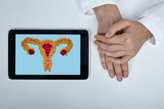 Doctor's hands on a desk next to a digital tablet displaying a floral uterus and ovaries design. Endometriosis treatment, uterine fibroids, and ovarian cyst diagnostics