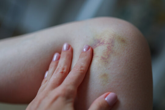 Female hand examining bruised knee with visible hematoma, concept of injury, pain, recovery and healthcare.