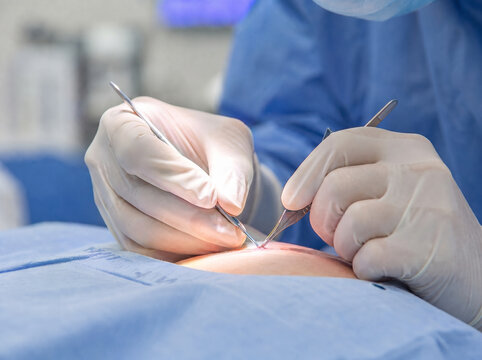 Surgeon Hands In Sterile White Gloves Performing Delicate Minor Surgical Procedure On Patient Skin, Professional Medical Healthcare Concept
