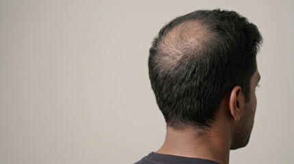 Naklejka premium Premium Medical Hair Restoration Hero Banner Showing Severe Crown Hair Density Reduction with Realistic Scalp Texture and Sparse Remaining Hair Strands.