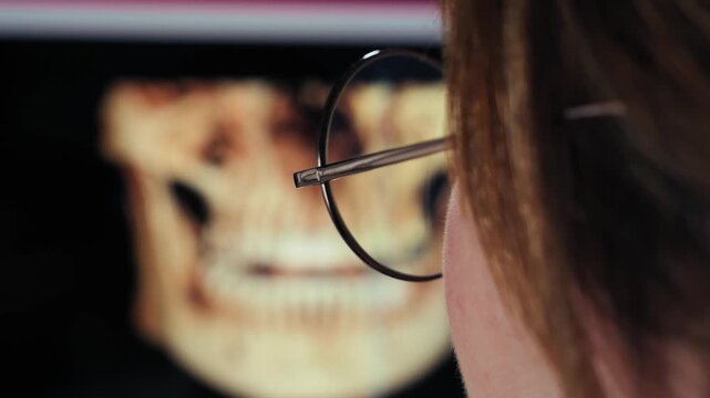 Dentist examining a 3D dental CT scan on a computer monitor before implant treatment. Close up of cone beam computed tomography analysis in a modern dental clinic. High quality 4k footage