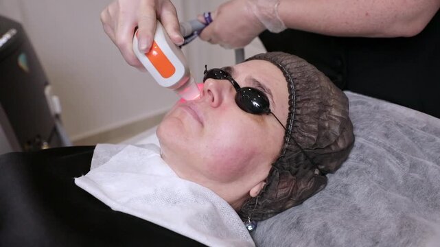 Woman in protective eyewear in skincare clinic. Doctor uses laser device for facial treatment. Decreased turgor, fine wrinkles, pigmentation, rosacea, dilated facial vessels. Photorejuvenation and IPL