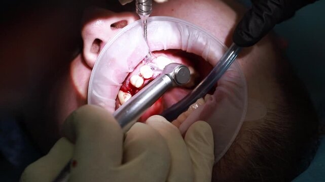 A dental surgeon prepares the gums for the installation of an abutment for a dental implant. A close-up of the mouth and instruments, a drill and a saliva ejector.