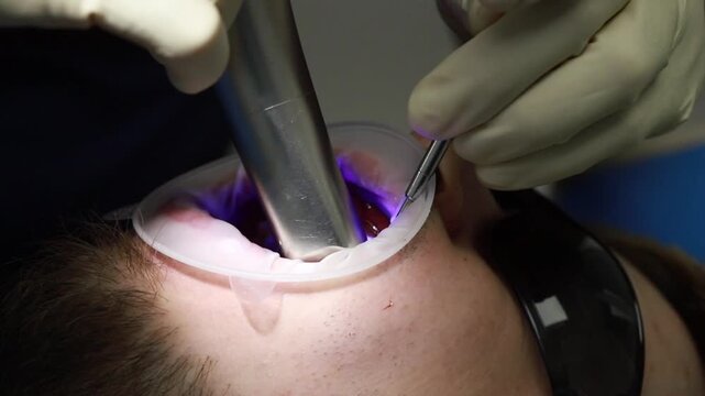 Intraoral scanner used during dental implant placement, capturing oral structures while dentist works with surgical instruments and illuminates implant site with scanning light