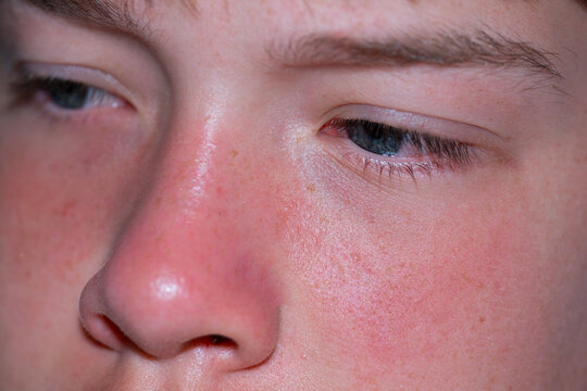 child's face with reddened sunburned cheeks and nose looking down close up skin texture detail outdoors in bright daylight concept of sun damage protection