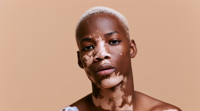 Young Black man with short bleached hair and extensive white vitiligo patches covering his face and neck, serious expression, beige studio background, generalized vitiligo, acrofac