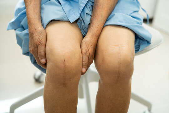 Asian elderly woman patient show her scars surgical total knee joint replacement Suture wound surgery arthroplasty on bed in hospital.