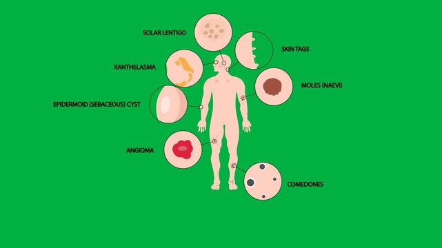 Medical vector animation displaying human body anatomy highlighting solar lentigo, xanthelasma, epidermoid cysts, angioma, seborrhoeic keratosis, dermatofibromas, comedones, pyogenic granuloma