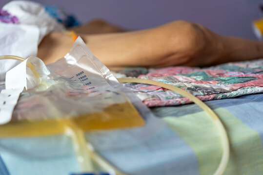 Urinary catheter drainage bag urine beside patient resting bed showing medical care equipment used for bladder drainage patient monitoring