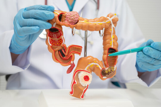 Colorectal cancer, doctor holding intestine colon human model.